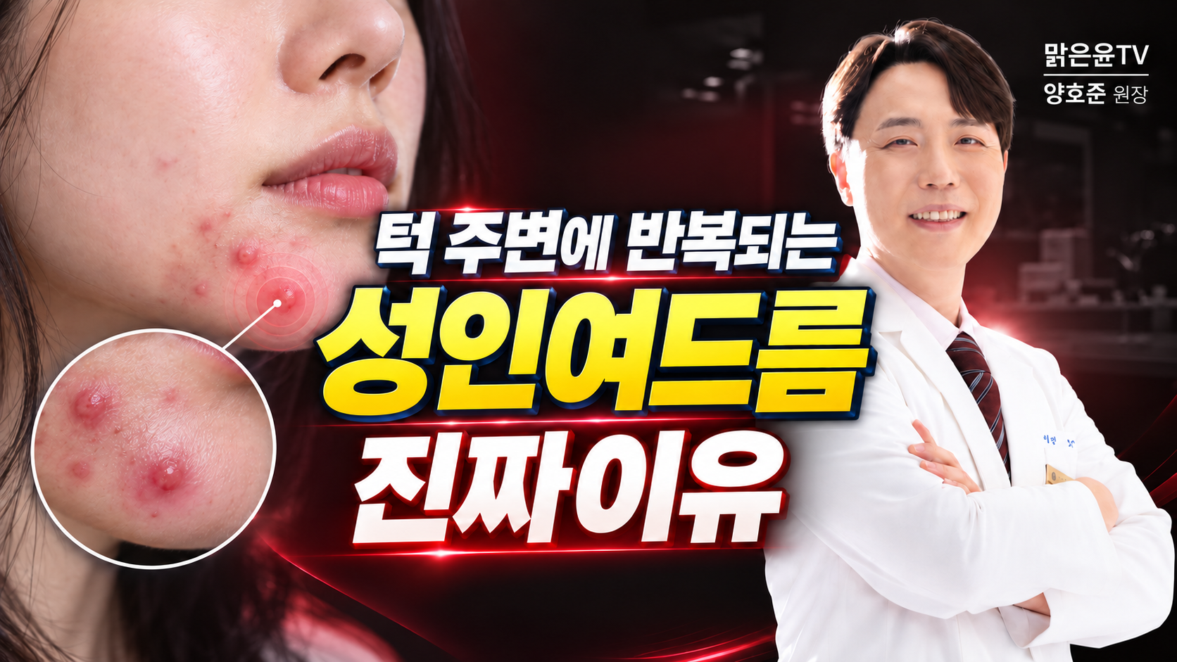 턱 주변에 반복되는 성인여드름, 진짜 이유는 무엇일까?